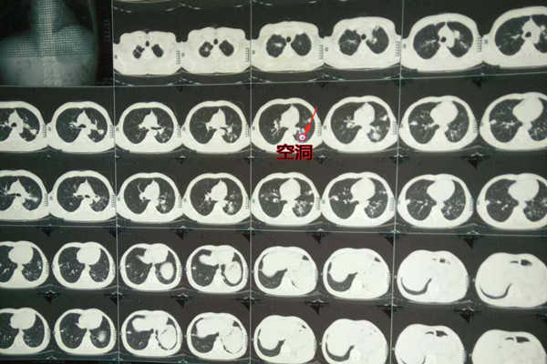 中醫怎么治療肺結核